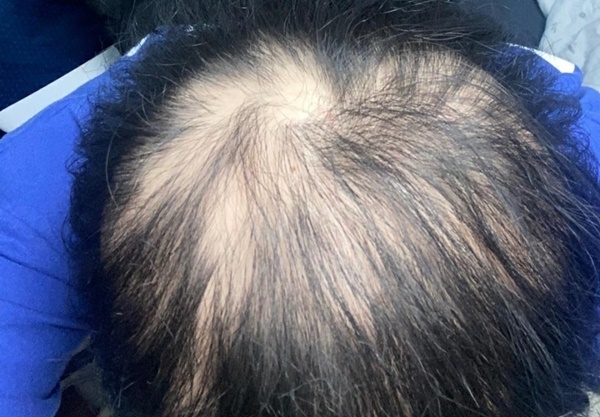 关于脱发与再生，十六岁的青春与头发的故事，脱发与再生，十六岁青春与头发的挑战