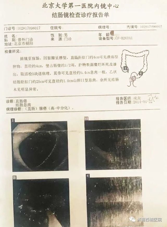 直肠癌四期患者生存奇迹，19年的坚韧与希望之路，直肠癌四期患者的生命奇迹，19年坚韧之路，希望永不止步