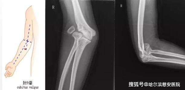 肘外翻20度兵检过了,一个关于健康与标准的探讨,健康与标准探讨,肘外翻20度如何通过兵检?