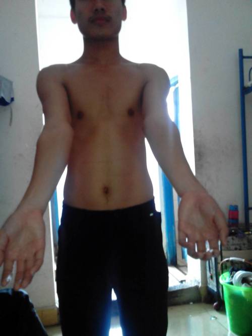 肘外翻20度兵检过了,一个关于健康与标准的探讨,健康与标准探讨,肘外翻20度如何通过兵检?